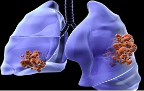 CANCER BRONCHO PULMONAIRE