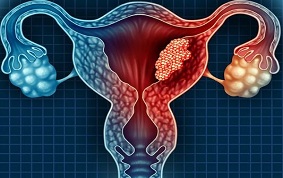 CANCER DU COL DE L’UTERUS