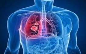 BRONCHOPNEUMOPATHIES CHRONIQUES OBSTRUCTIVES