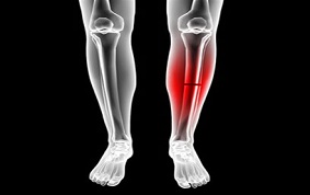 FRACTURES OUVERTES DE LA JAMBE