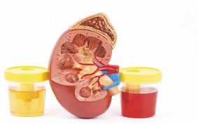 HEMATURIES