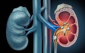 LITHIASE URINAIRE