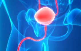 TUMEURS DE LA PROSTATE