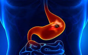 ULCÈRE GASTRIQUE ET DUODÉNAL